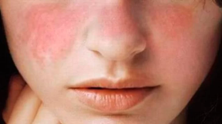 Lupus: una enfermedad que avanza en silencio