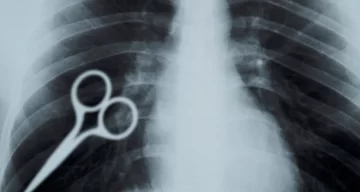 Un preso se tragó una tijera como acto de protesta y debió ser hospitalizado Un preso se tragó una tijera como acto de protesta y debió ser hospitalizado