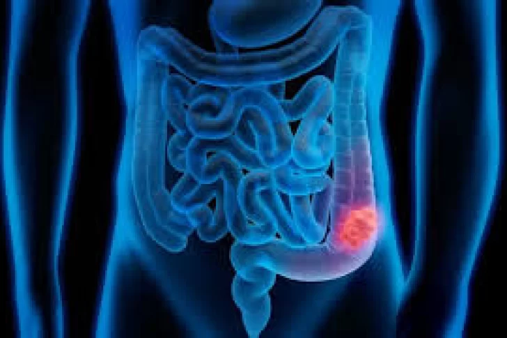 Cada día se suman más de 40 casos de cáncer de colon