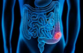 Cada día se suman más de 40 casos de cáncer de colon
