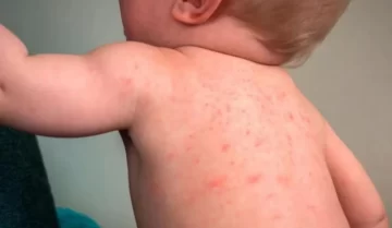 Brote de sarampión en Argentina: ya son 26 los casos confirmados este año