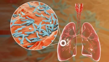 Argentinos desarrollaron un test rápido y de bajo costo para el diagnóstico de la tuberculosis Argentinos desarrollaron un test rápido y de bajo costo para el diagnóstico de la tuberculosis