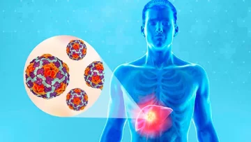 Alerta por brote de hepatitis A en Argentina: ya reportaron 69 casos en 13 distritos