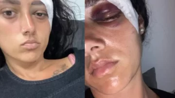 Viajó a Turquía con su hijo y terminó con 40 puntos en la cabeza: “Pensé que me moría” Viajó a Turquía con su hijo y terminó con 40 puntos en la cabeza: “Pensé que me moría”