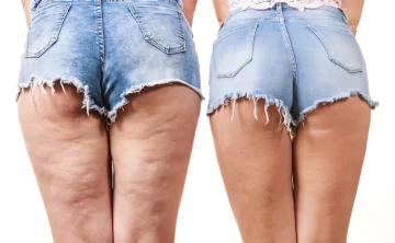 Cómo reafirmar la piel y disminuir la celulitis Cómo reafirmar la piel y disminuir la celulitis