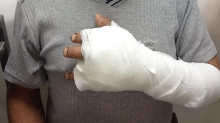 Albardón: un obrero terminó con tres dedos heridos tras un accidente con una amoladora