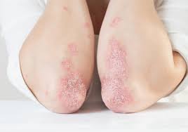 Más del 20% de las personas con psoriasis en Argentina presenta formas severas de la enfermedad