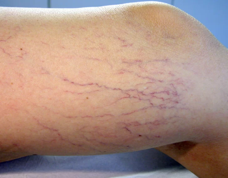 aranita-apertura-728x568