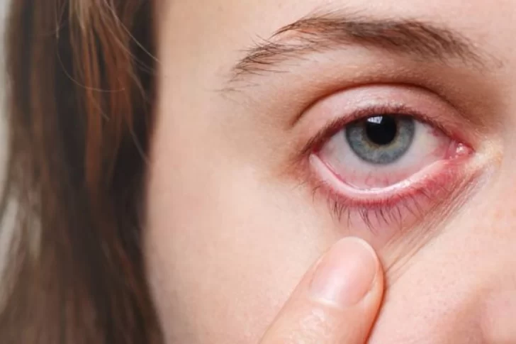 El grave error que casi deja ciega a una joven: se duchó con lentes de contacto