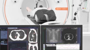 El Hospital Marcial Quiroga lanzó un programa gratuito de detección temprana de cáncer de pulmón