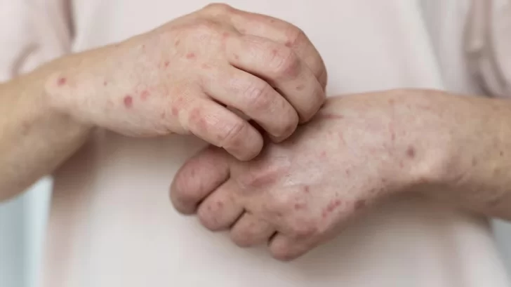 Sarampión: cómo prevenirlo, síntomas y cómo se contagia Sarampión: cómo prevenirlo, síntomas y cómo se contagia